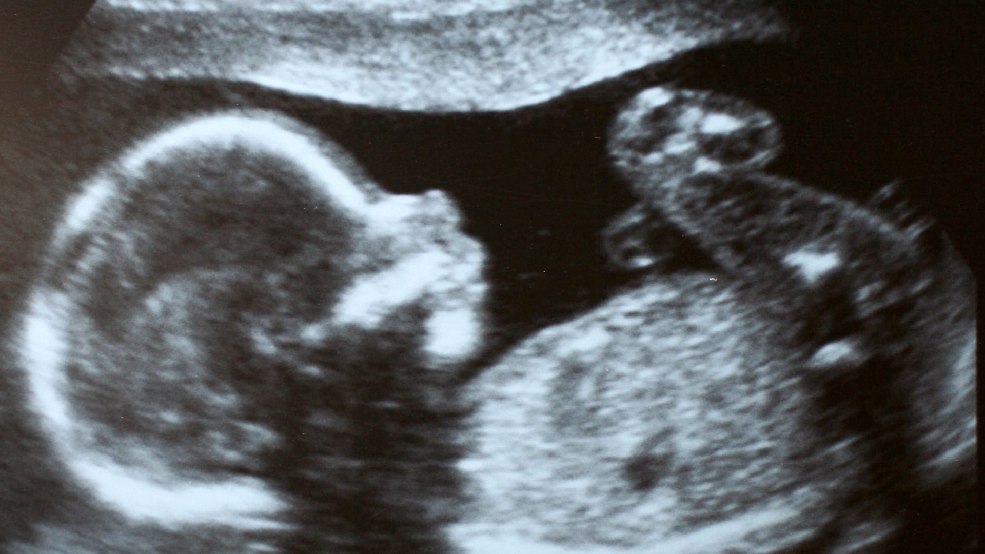 update 13 weken echo